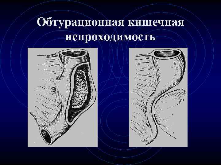 Обтурационная кишечная непроходимость 