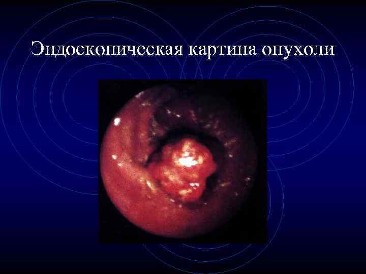 Эндоскопическая картина опухоли 