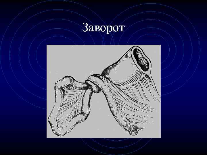 Заворот 