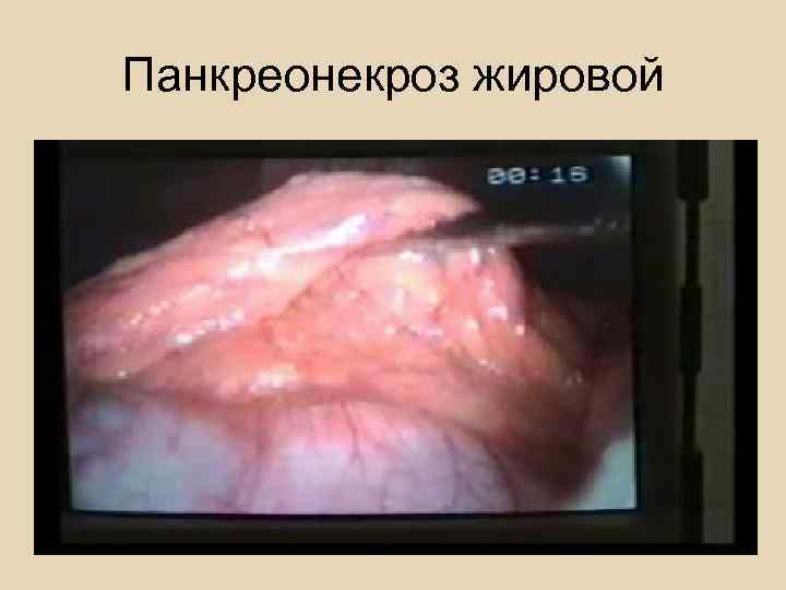 Лапароскопия при жировом панкреонекрозе 