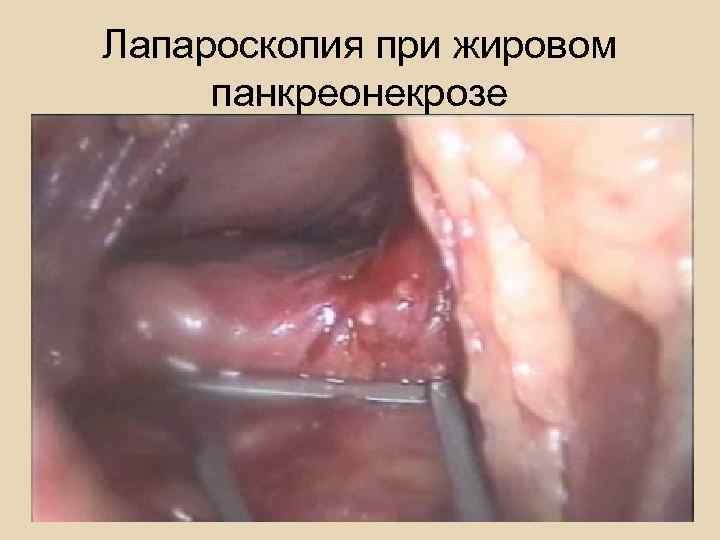 Стеатонекрозы 