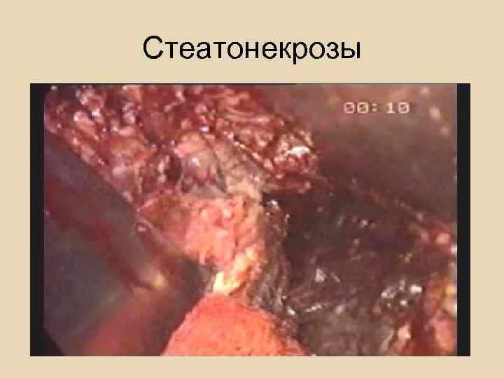 Геморрагический панкреонекроз 