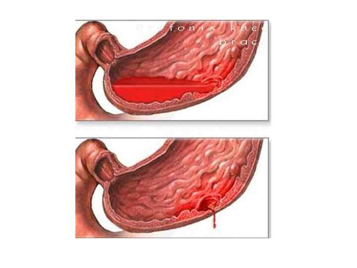 Зонд Блекмора (С-м Меллори-Вейсса) 