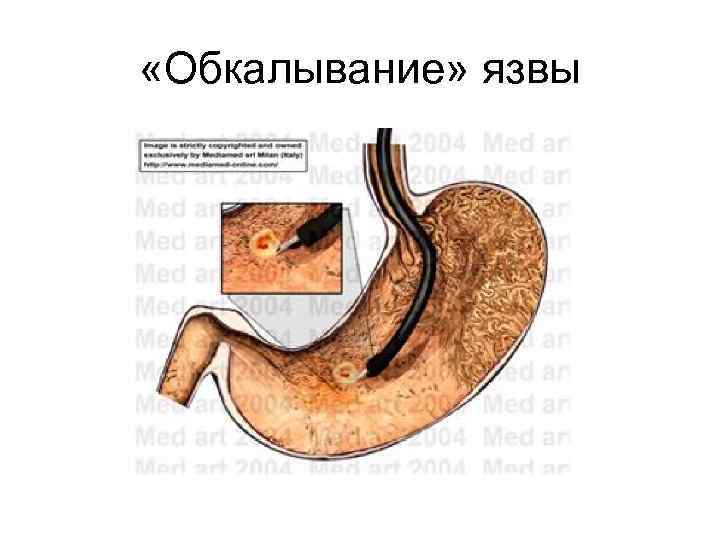 Зонд Блекмора 