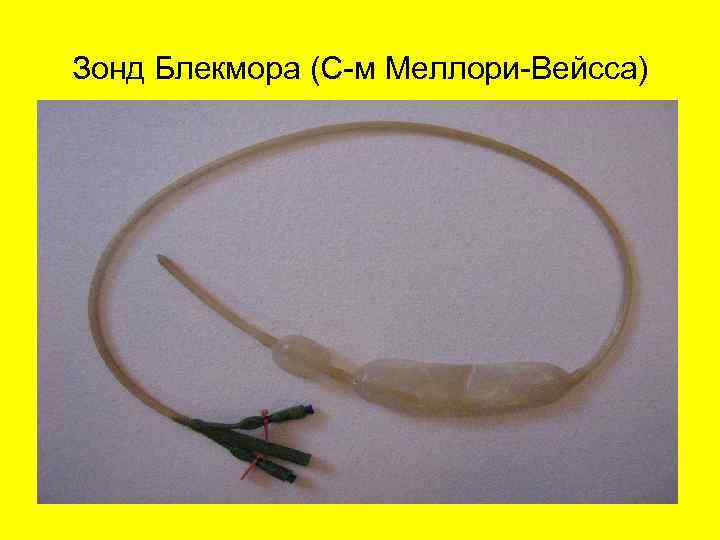  Перфорация или прободение  язвы • это нарушение целостности стенки желудка или 12