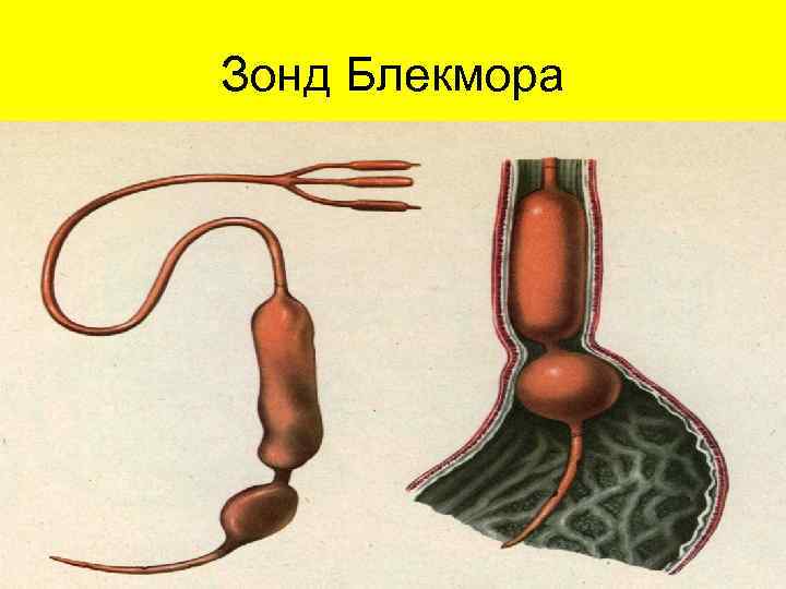  Триада Мондора:  • наличие язвенного анамнеза;  •  «кинжальные» боли; 