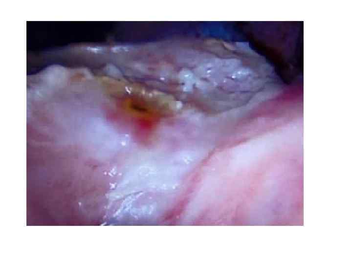 Пенетрация язвы в головку поджелудочной железы 