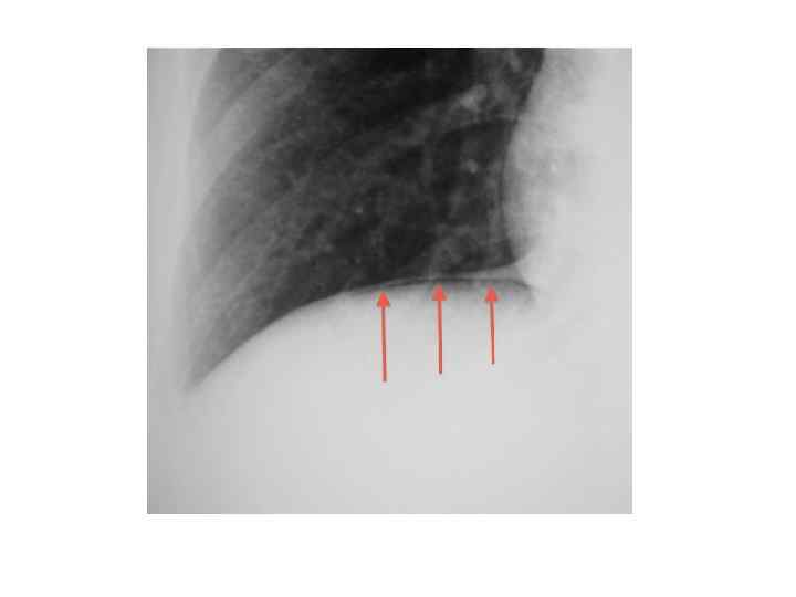 Пенетрация в печень 