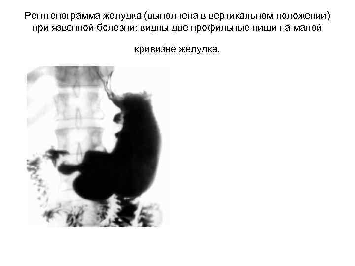 Рентгенограмма желудка (выполнена в вертикальном положении) при язвенной болезни: видны две профильные ниши на