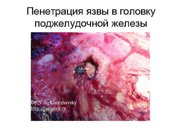  Лечение осложнений • ТОЛЬКО оперативное.  • СРОЧНАЯ госпитализация в стационар • Больного