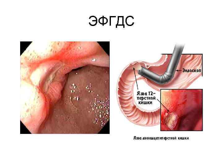 ЭФГДС 