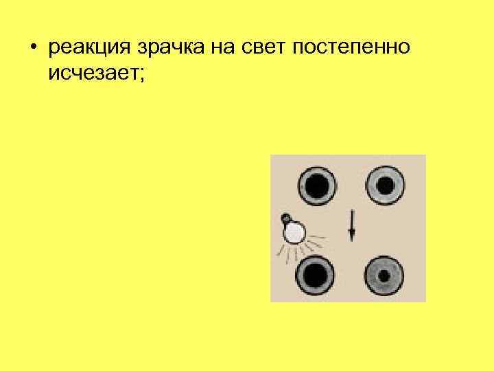 Реакция зрачка на свет. Реакция зрачков на свет. Проверка реакции зрачков на свет. Реакция зрачков на свет в норме. Реакция зрачка на свет классификация.