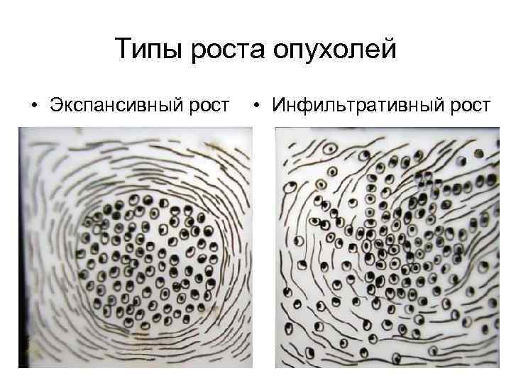   Типы роста опухолей • Экспансивный рост  • Инфильтративный рост 