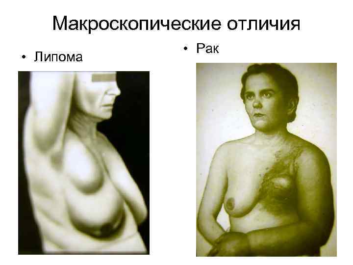   Макроскопические отличия   • Рак • Липома 