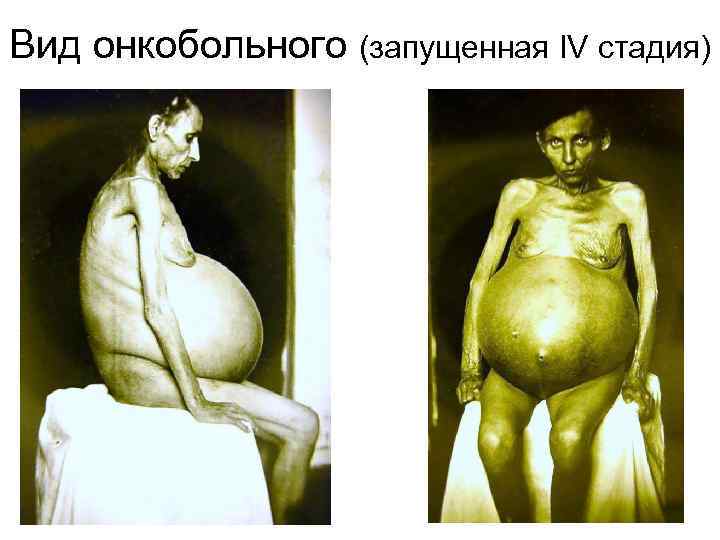 Вид онкобольного (запущенная IV стадия) 