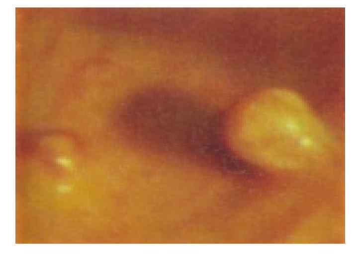 Злокачественные опухоли:  Рак,  Аденокарцинома, Плоскоклеточный рак,  Базилиома, Саркома, Фибросаркома,  Хондросаркома,