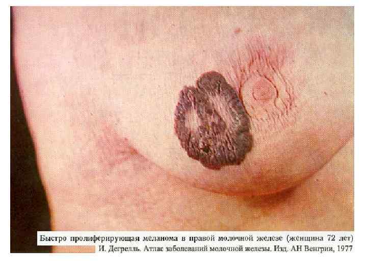     Т - tumor • T 0 – нет признаков первичной