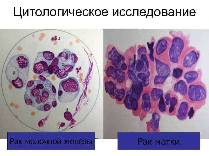   Облигатный предрак • как правило, обусловлен генетическими или  врождёнными факторами и