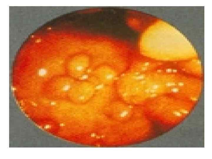   Общие принципы лечения   опухолей • Доброкачественные опухоли лечат  чаще