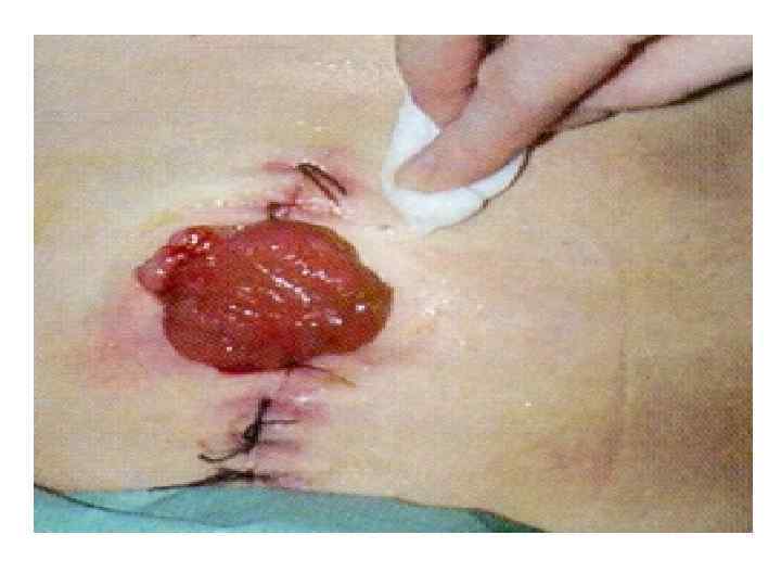   Способы облучения • 1. Дистанционное - источники излучения  находятся на определенном