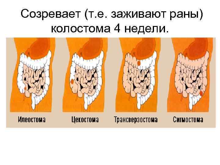 Осложнения лучевой терапии • Лучевые реакции: эпителиит, дерматит, цервицит, ларингит, ректосигмоидит, энтероколит, цистит. •