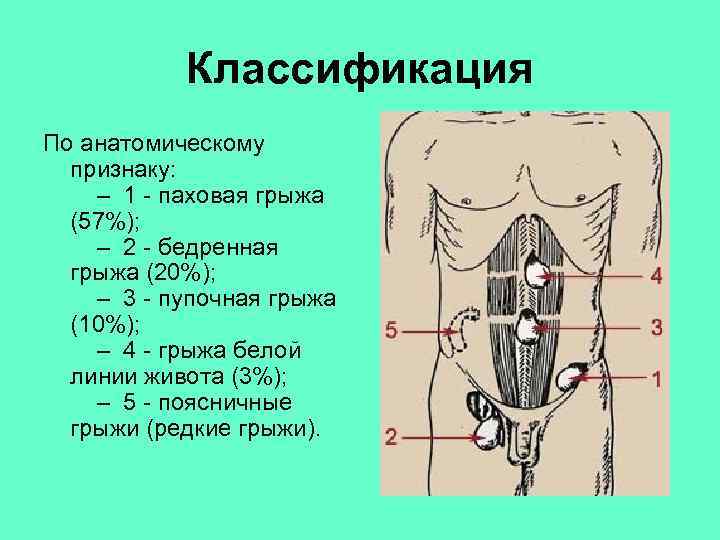  Классификация По анатомическому признаку: – 1 - паховая грыжа (57%); – 2 -