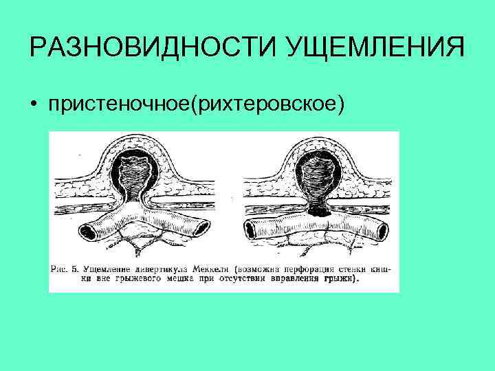 РАЗНОВИДНОСТИ УЩЕМЛЕНИЯ • пристеночное(рихтеровское) 