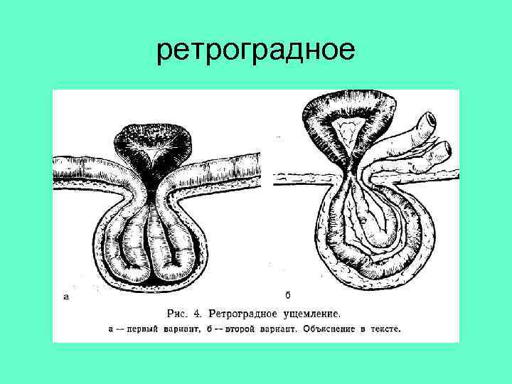 ретроградное 