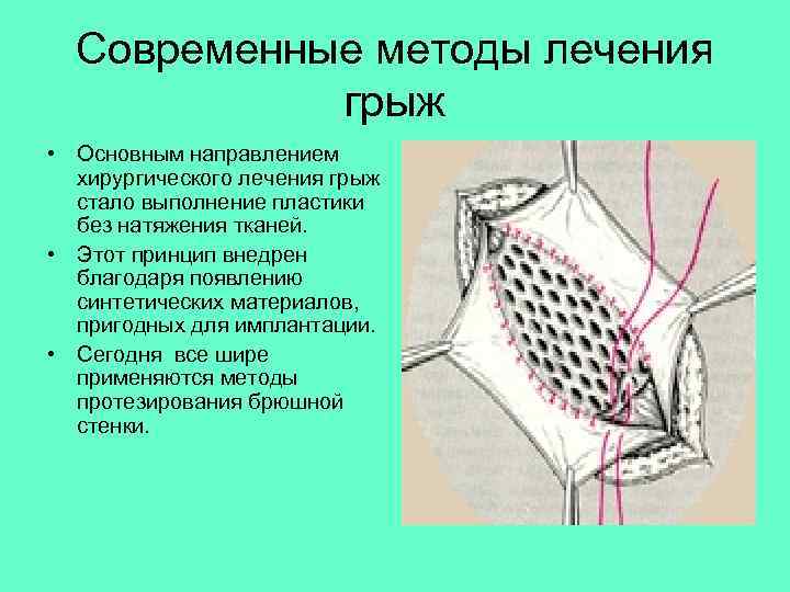  Современные методы лечения грыж • Основным направлением хирургического лечения грыж стало выполнение пластики