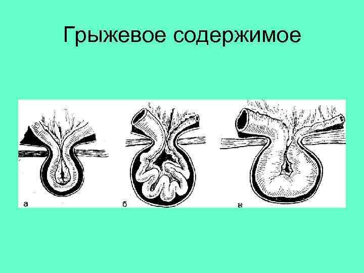 Грыжевое содержимое 