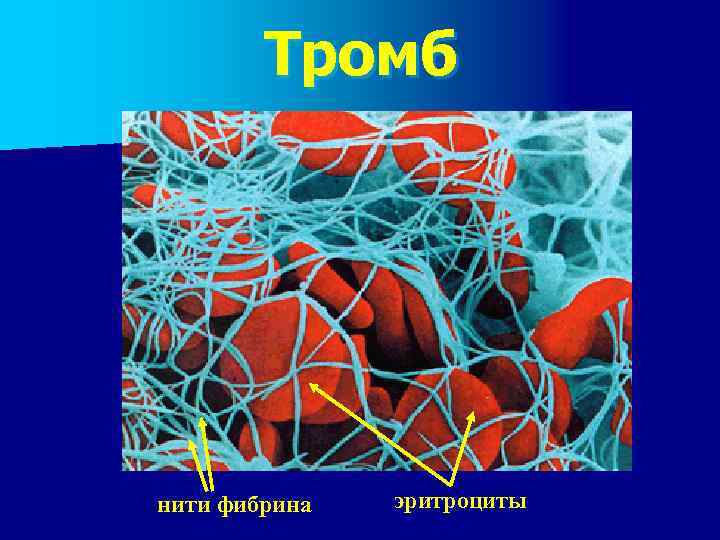  Тромб нити фибрина  эритроциты 