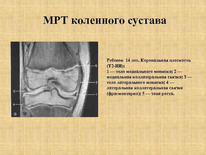 МРТ коленного сустава Ребенок 14 лет. Корональная плоскость (Т 2 -ВИ): 1 — тело