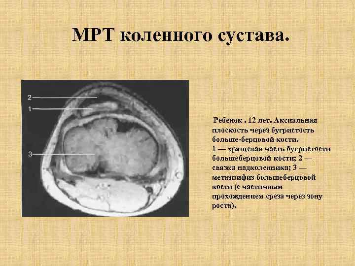 МРТ коленного сустава. Ребенок. 12 лет. Аксиальная плоскость через бугристость больше-берцовой кости. 1 —