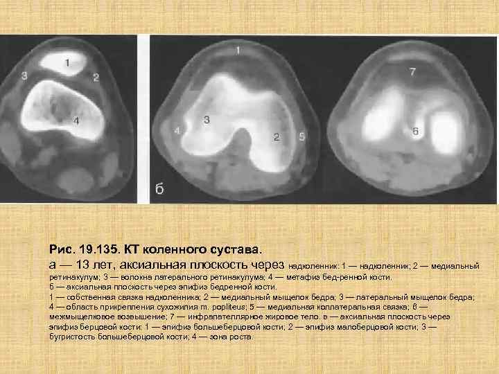 Рис. 19. 135. КТ коленного сустава. а — 13 лет, аксиальная плоскость через надколенник: