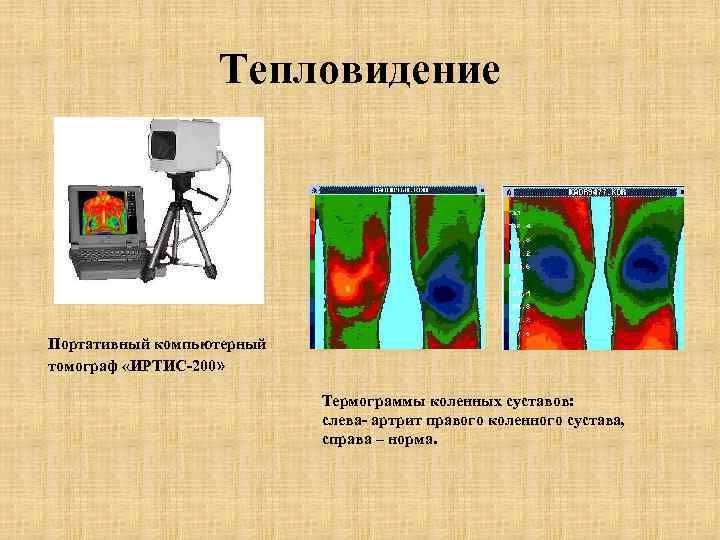  Тепловидение Портативный компьютерный томограф «ИРТИС-200» Термограммы коленных суставов: слева- артрит правого коленного сустава,