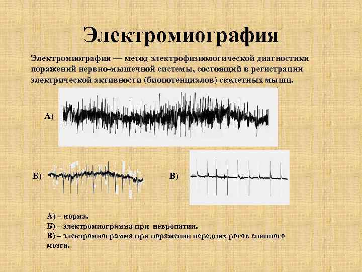  Электромиография — метод электрофизиологической диагностики поражений нервно-мышечной системы, состоящий в регистрации электрической активности