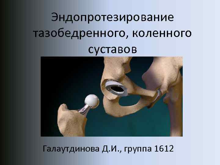  Эндопротезирование тазобедренного, коленного суставов Галаутдинова Д. И. , группа 1612 