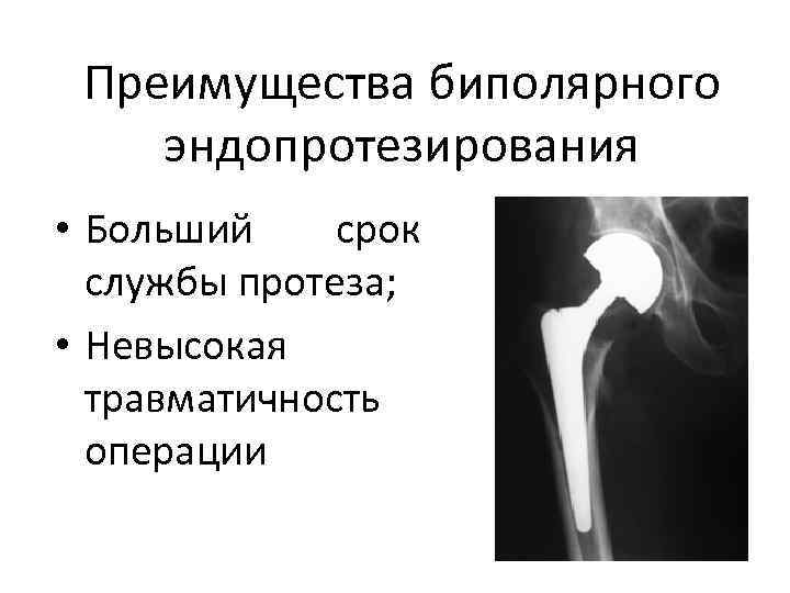  Преимущества биполярного эндопротезирования • Больший срок службы протеза; • Невысокая травматичность операции 