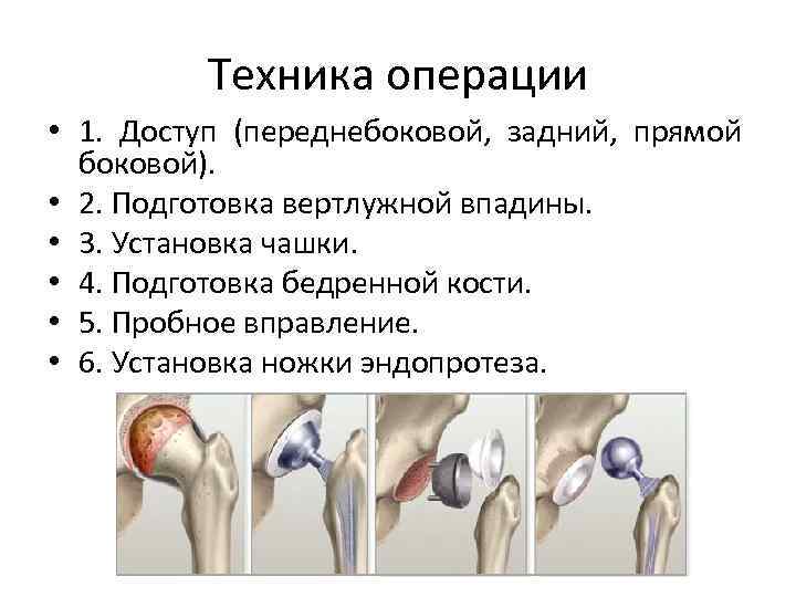  Техника операции • 1. Доступ (переднебоковой, задний, прямой боковой). • 2. Подготовка вертлужной