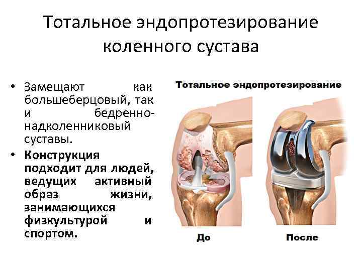  Тотальное эндопротезирование коленного сустава • Замещают как большеберцовый, так и бедренно- надколенниковый суставы.