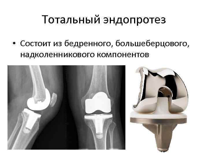  Тотальный эндопротез • Состоит из бедренного, большеберцового, надколенникового компонентов 