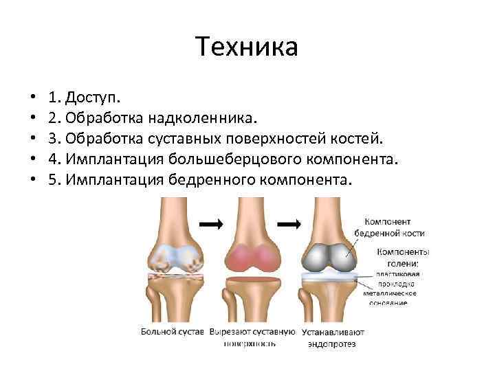  Техника • 1. Доступ. • 2. Обработка надколенника. • 3. Обработка суставных поверхностей