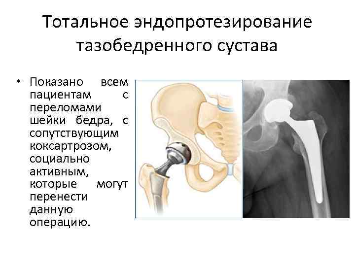  Тотальное эндопротезирование тазобедренного сустава • Показано всем пациентам с переломами шейки бедра, с