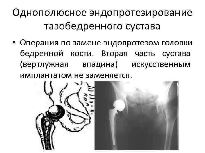 Однополюсное эндопротезирование тазобедренного сустава • Операция по замене эндопротезом головки бедренной кости. Вторая часть