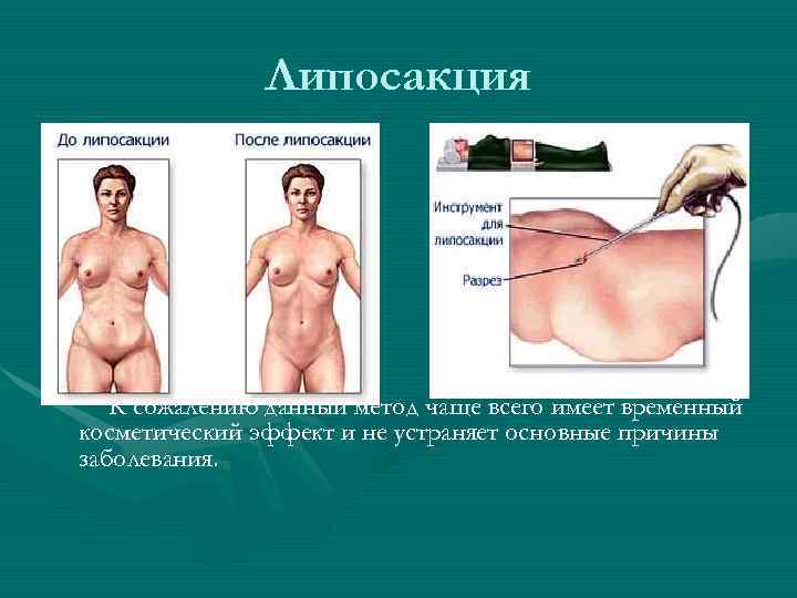  Липосакция К сожалению данный метод чаще всего имеет временный косметический эффект и не