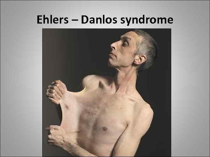 Ehlers – Danlos syndrome 