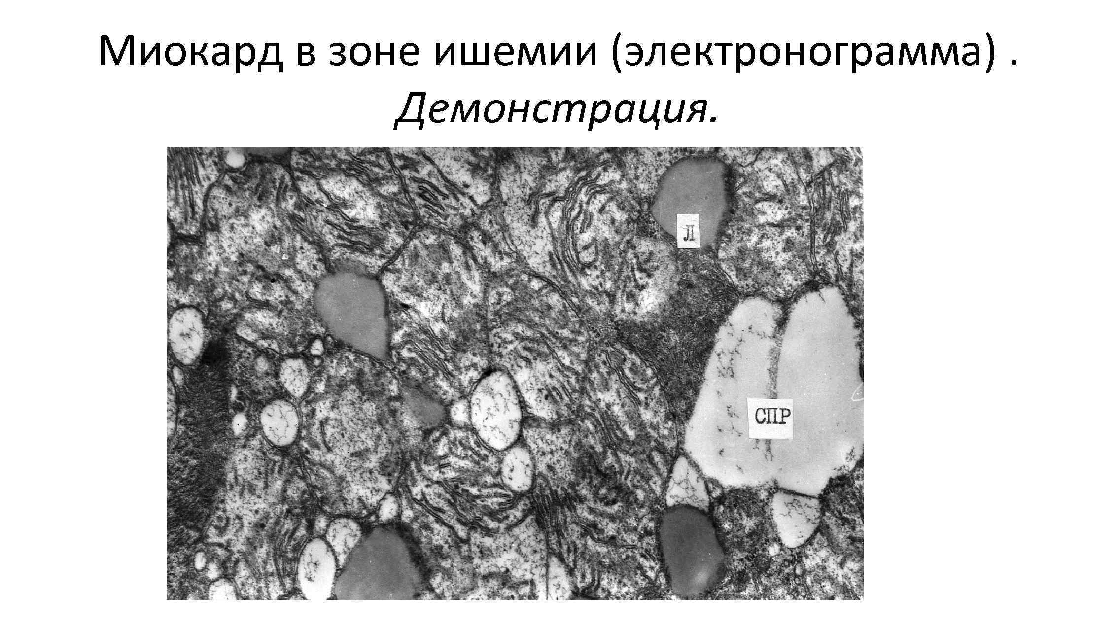 Миокард в зоне ишемии (электронограмма).    Демонстрация. 