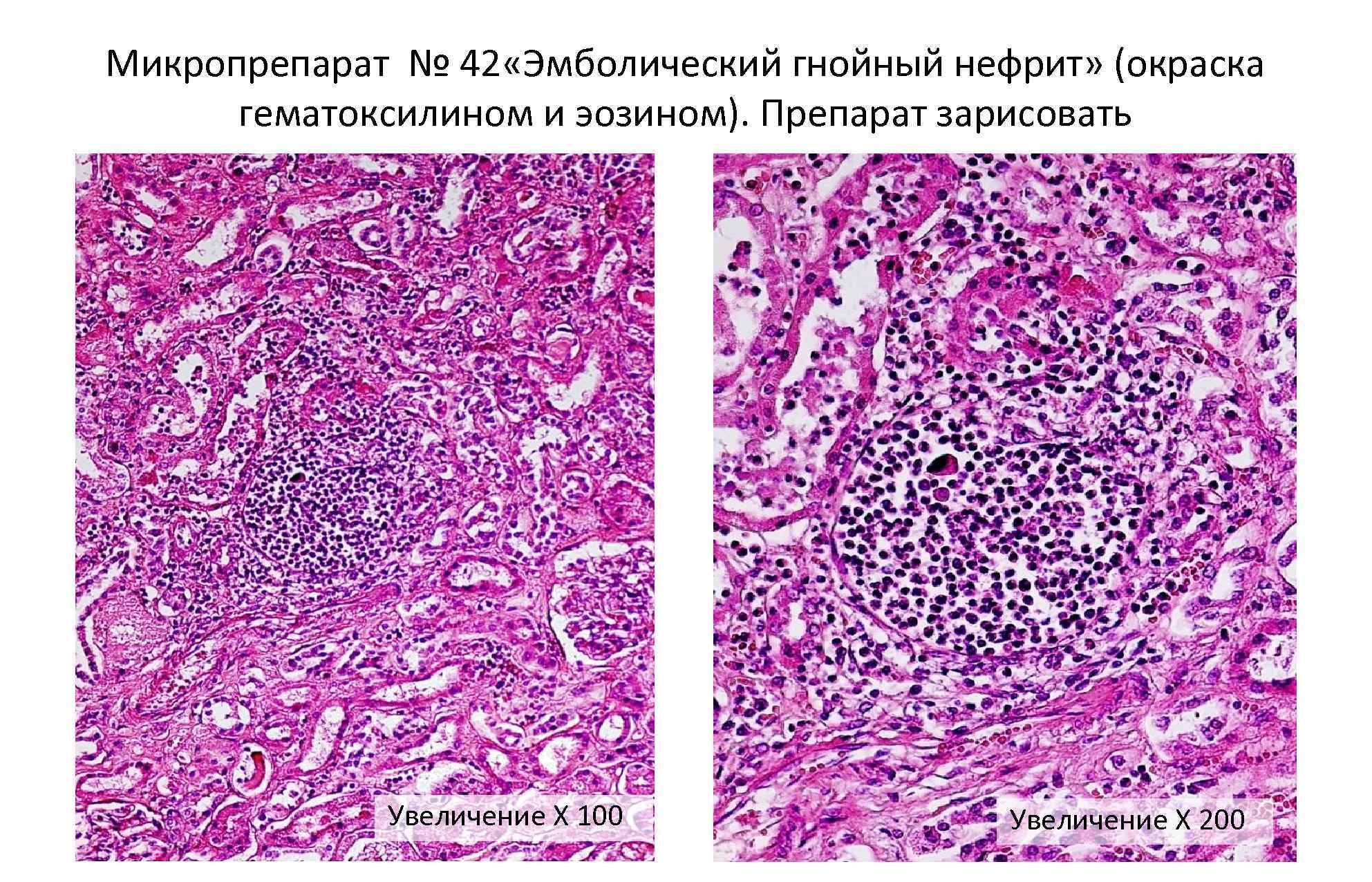 Микропрепарат № 42 «Эмболический гнойный нефрит» (окраска гематоксилином и эозином). Препарат зарисовать Увеличение Х