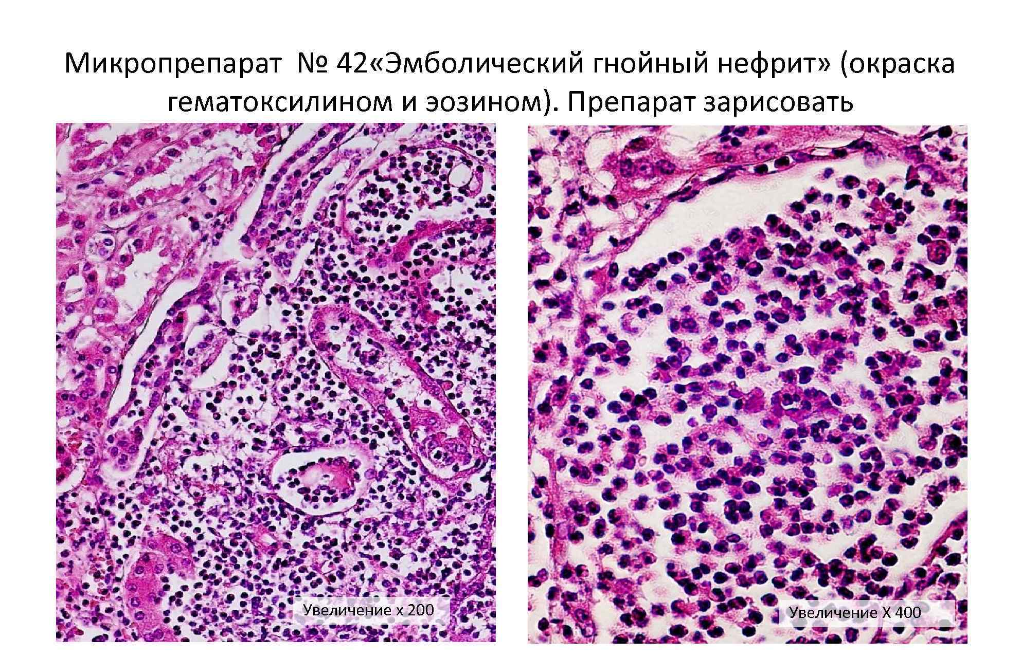 Гнойный пиелонефрит микропрепарат