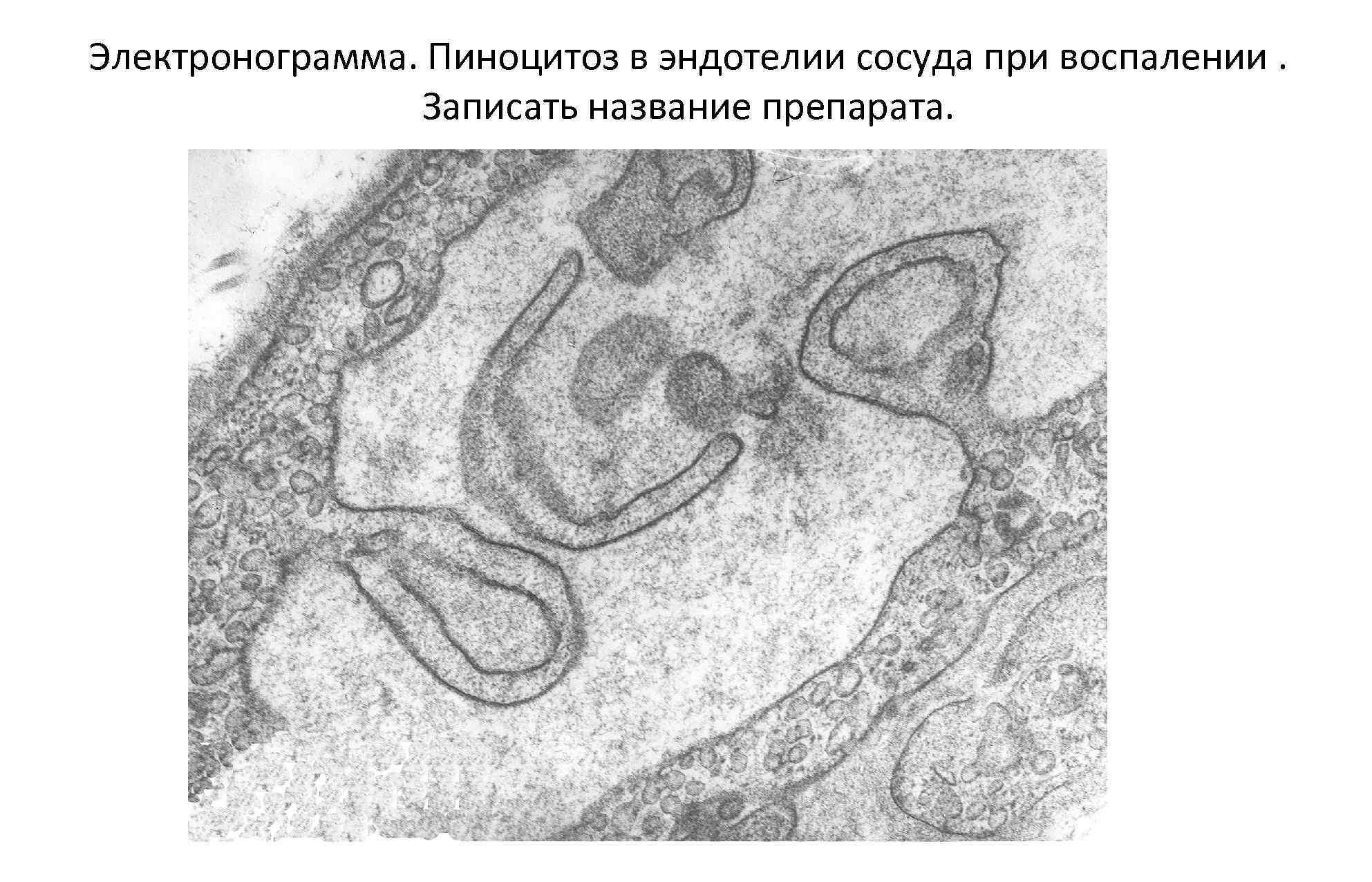 Проведите дифференциальный диагноз между крупозным и дифтеритическим воспалением по следующей схеме